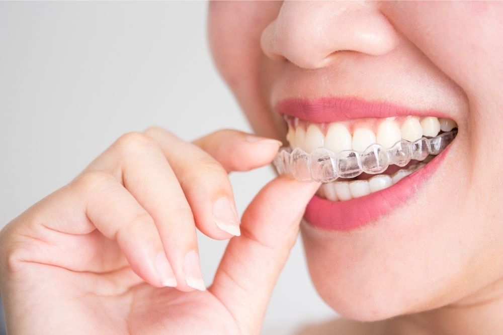 Being Prepared for Your Invisalign Treatment